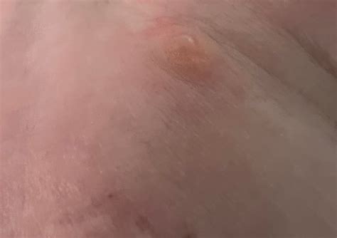 Is this a Brown Recluse bite? N. GA : r/BrownRecluseBites