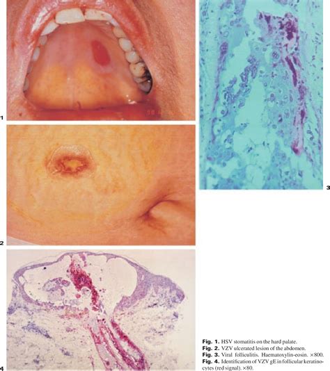 Herpetic Stomatitis Histology