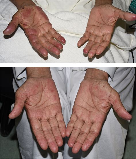 Atypical Palmar Involvement with Erythema Elevatum Diutinum as a Sole ...