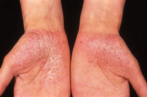 Recognizing and Managing Flares in Generalized Pustular Psoriasis