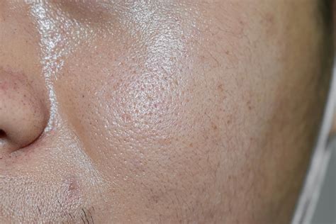 oily skin treatments wimbledon kensington skin type london