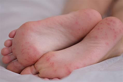 Managing Your Non-Diabetic Foot Infection