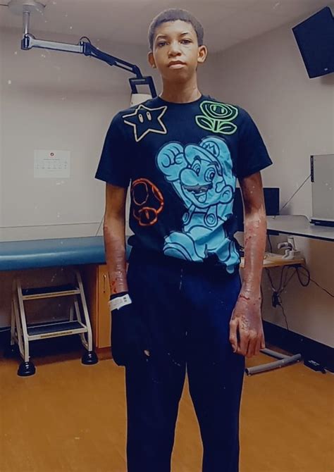 My son caught on fire doing a viral stunt — I tried to put it out with