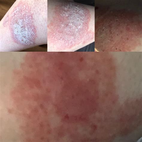 Say Goodbye to Psoriasis Symptoms with Otezla Treatment Now 1