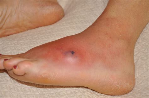 Brown Recluse Spider Bite | atelier-yuwa.ciao.jp