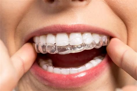 What No One Tells You About Invisalign | PSS (Herts)