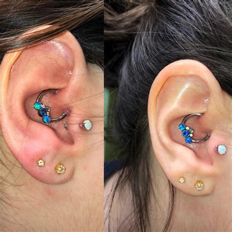Hypertrophic Scar Piercing