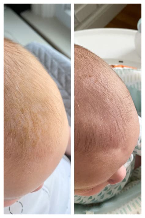 cradle cap before and after - Lovely Lucky Life