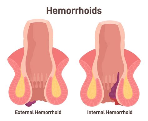 understanding hemorrhoids vein institute