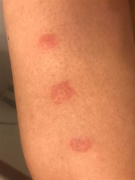 piqures de punaises de lit symptomes traitement  prevention soluty