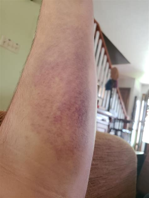 Forearm after cliff jumping into a lake : r/Wellthatsucks