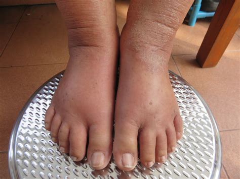 Severe Edema