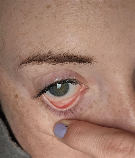 Anemia Eye Test Replying To @d.daina How You Can Identify Anaemia From