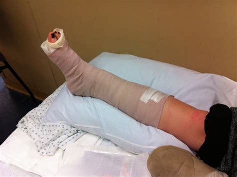 how to know if you break your ankle