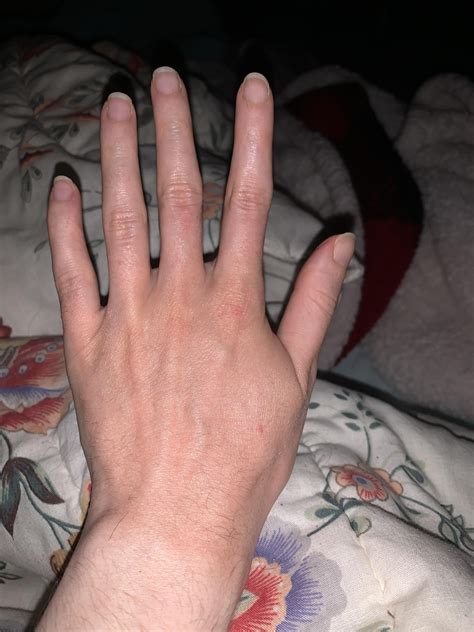 Over washed hands/itchy red bumps : r/Skincare_Addiction