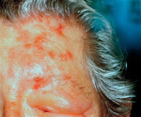 mbbs herpes zoster ophthalmicus