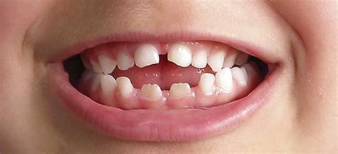 Dente De Quem Usa Bico - Chupeta e Bico - Dentista Legal
