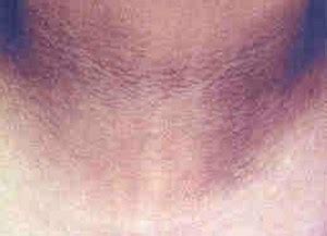 Acanthosis Nigricans - Pictures, Symptoms, Causes, Treatment