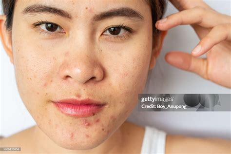 close   woman face   problem  acne  scar  acne