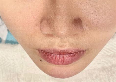 Stem Cell Filler Pen - Vary Beauty