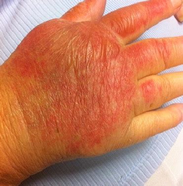 stages   degree burn healing   expect