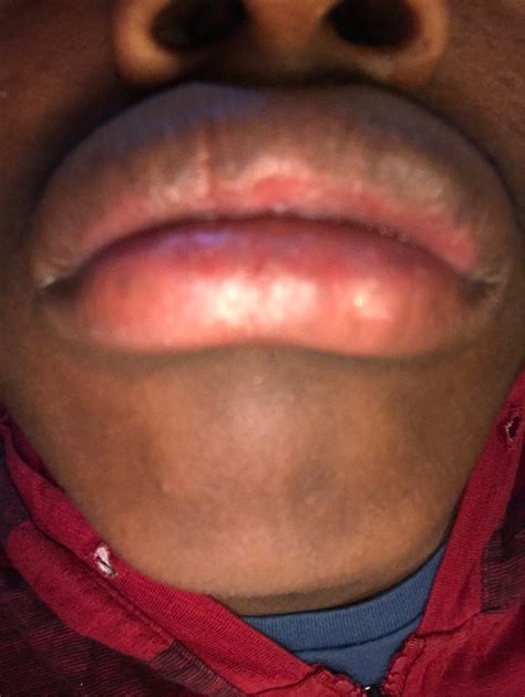 topical cream gel - Pealing lips problem - Medical Sciences Stack Exchange