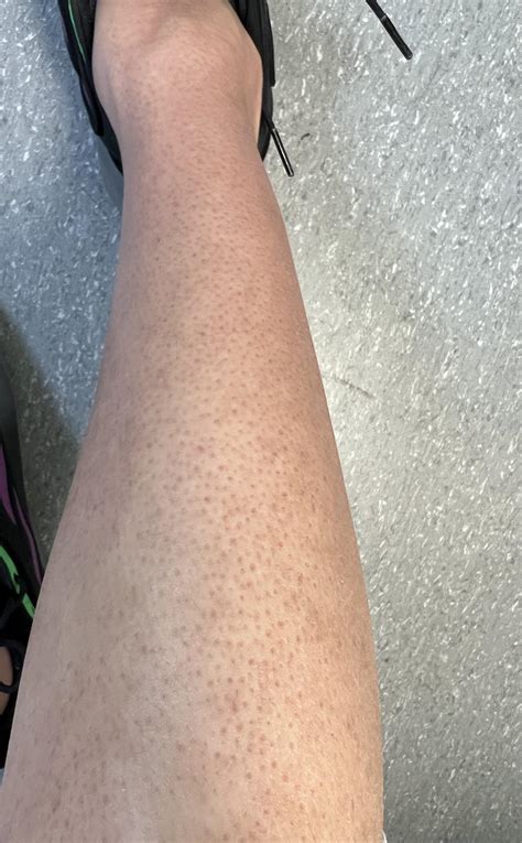 Fungal or Bacterial Folliculitis on Groin? : r/Folliculitis