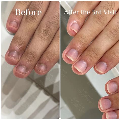 How We Helped a Client Heal From Chronic Nail Biting at Atelier Anaiis