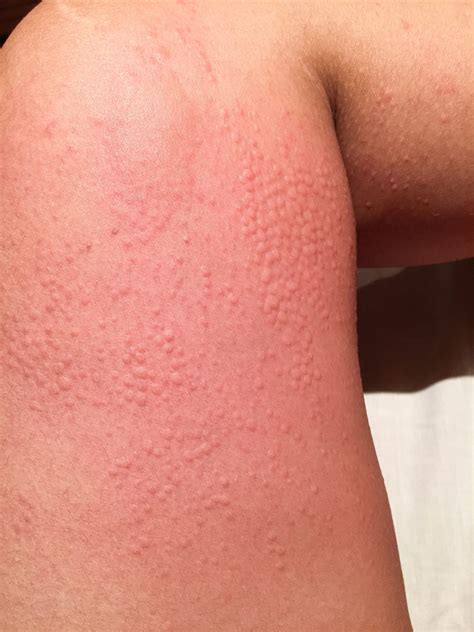 What is a Cold Rash? Cold Urticaria Explained - Sonali Majmudar Allergy