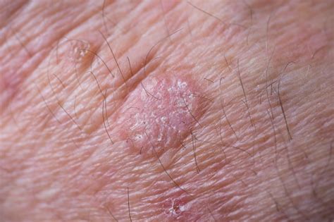 types  actinic keratosis