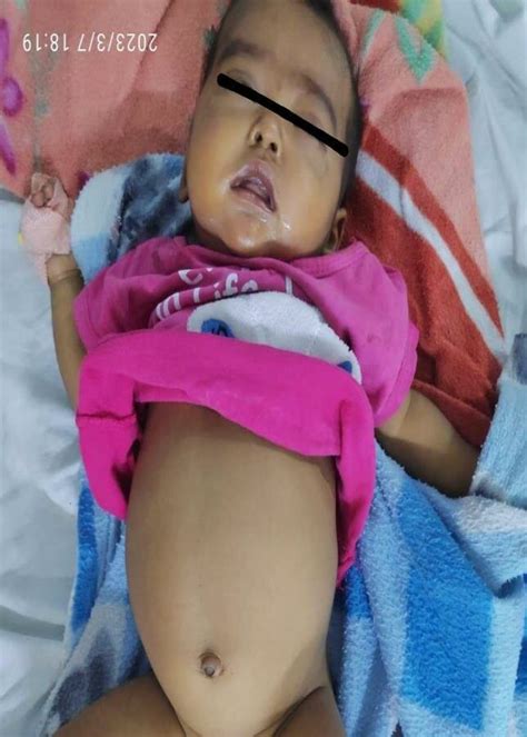 Infant with neonatal cholestasis showing abdominal distension ...