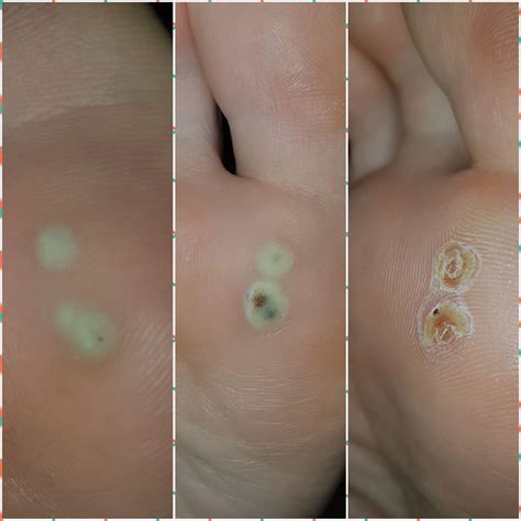 Another wart progress photo. They are slowly starting to separate from