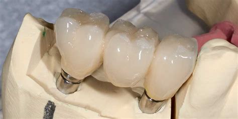 Implant Supported Bridges | Stuart Prosthetic Dentistry