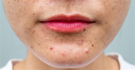 acne treatment types  prevention