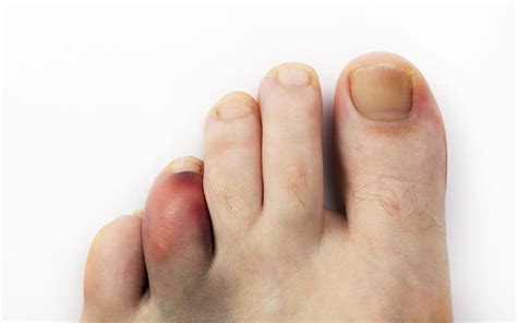 helping sprained toes heel kaatsu canada