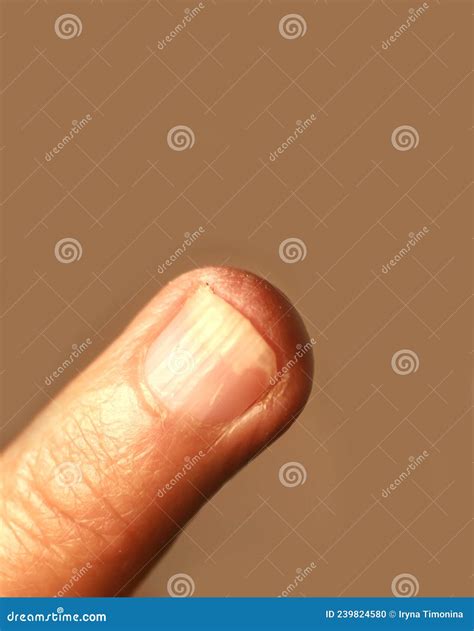 Fungal Infection Under the Nail. a Finger on a Hand with a Fungal