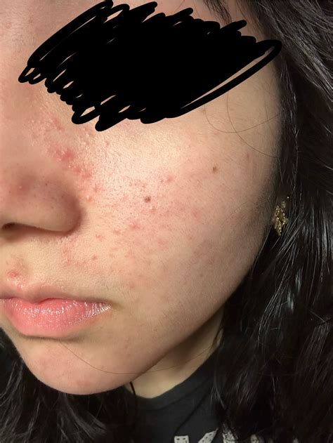 recently took antibiotics and broke out! pls help me – Acne – Acne.org