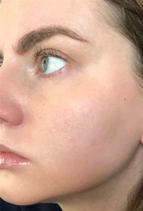 Steroid Creams, Aklief, Epsolay? : r/Rosacea