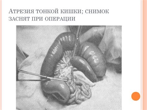 Лечение атрезии тонкого кишечника - презентация онлайн