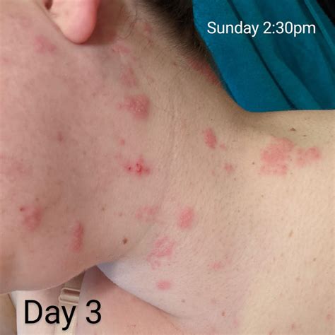 Shingles Timeline in Photos (just in case it is helpful/interesting to