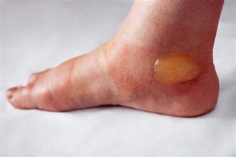 foot blisters treatment  steady gait foot clinic  scarborough