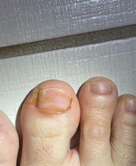 Is this nail fungus? Noticed orange stains on big toe : r/NailFungus