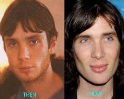 Cillian Murphy Before And After Plastic Surgery