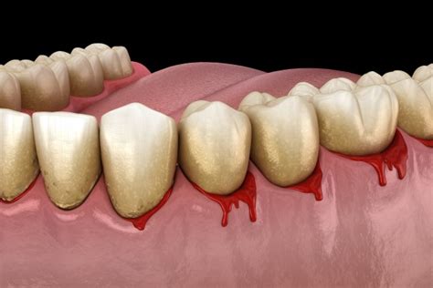 Dente Sangrando O Que Pode Ser - O que pode ser o sangramento no dente? - Dentista Vip