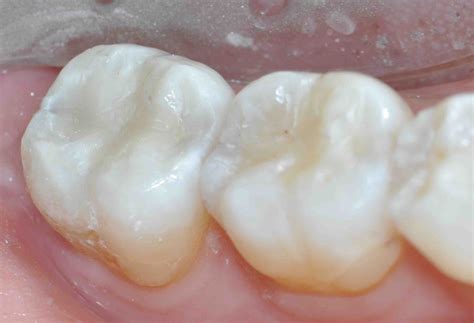 Composites & Wear - Lee Ann Brady, DMD's Dental Blog