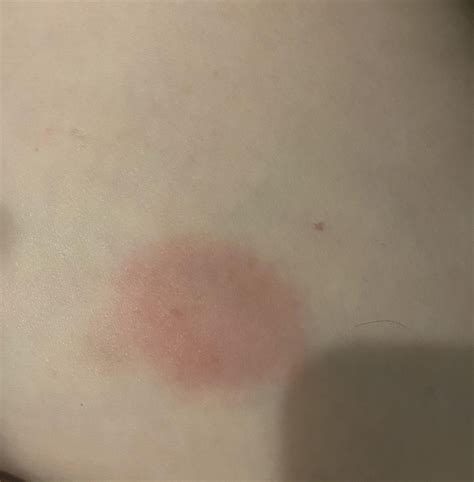 Mounjaro inj site reaction? : r/Mounjaro