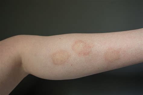 Infected and Inflamed Insect Bites on Leg Stock Photo - Image of bite ...