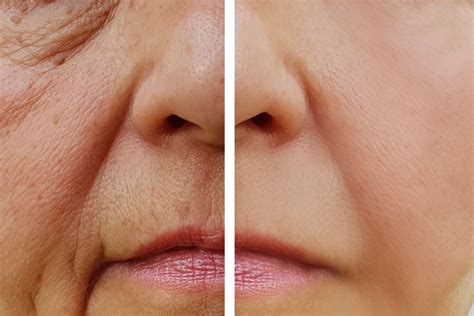 5 Types of Wrinkles & Their Prevention - Health Supplies Plus