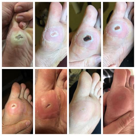 Plantar Wart Healing Process at Erin Mackenzie blog