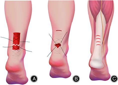 A New Technique of Achilles Tendon Rupture Repaired by Double ...